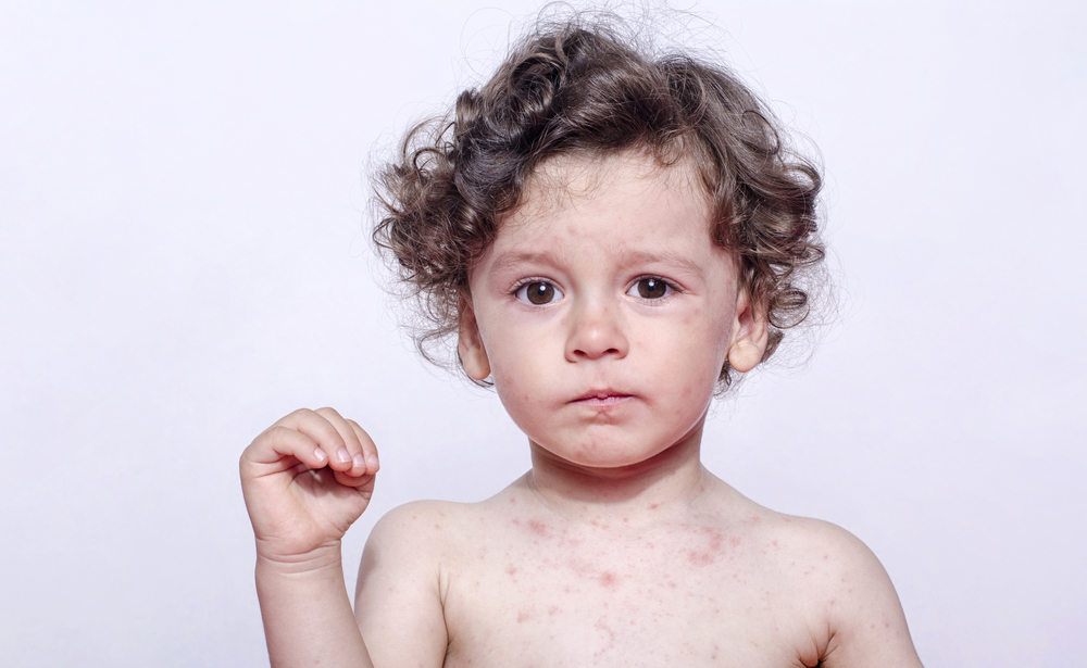 Bei Kindern verläuft eine Röteln-Infektion meist ohne Komplikationen.